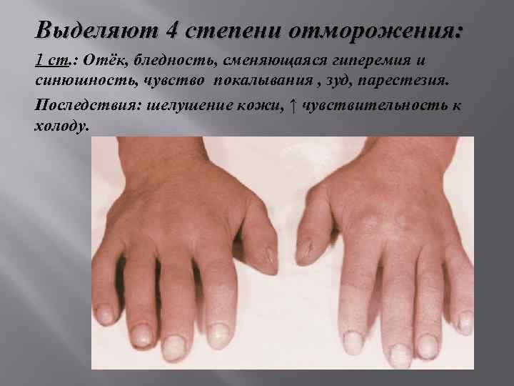 Выделяют 4 степени отморожения: 1 ст. : Отёк, бледность, сменяющаяся гиперемия и синюшность, чувство