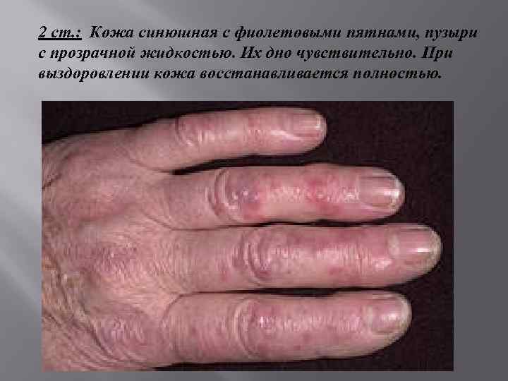 2 ст. : Кожа синюшная с фиолетовыми пятнами, пузыри с прозрачной жидкостью. Их дно