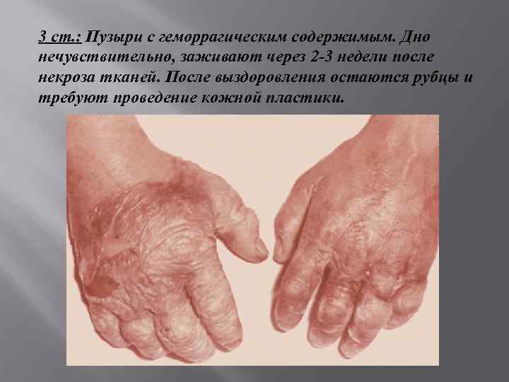 3 ст. : Пузыри с геморрагическим содержимым. Дно нечувствительно, заживают через 2 -3 недели