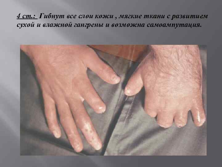 4 ст. : Гибнут все слои кожи , мягкие ткани с развитием сухой и