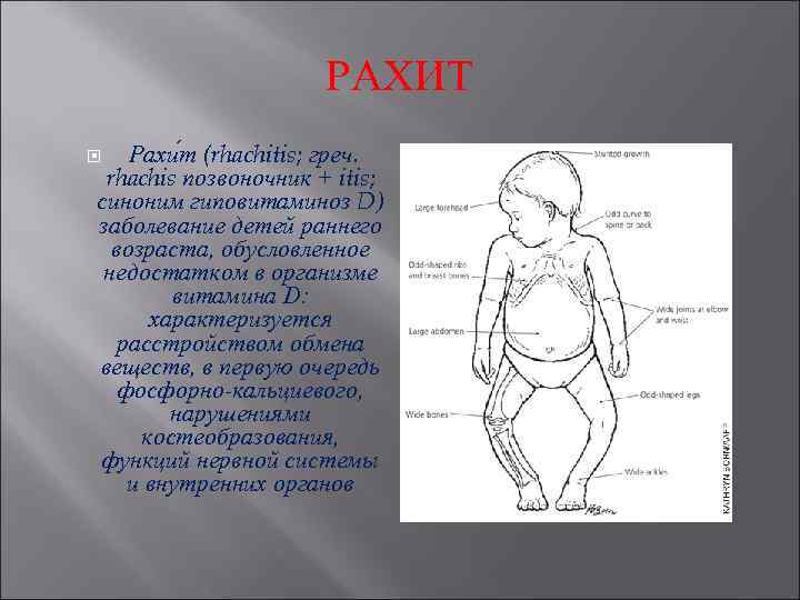 РАХИТ Рахи т (rhachitis; греч. rhachis позвоночник + itis; синоним гиповитаминоз D) заболевание детей