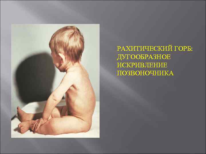  РАХИТИЧЕСКИЙ ГОРБ: ДУГООБРАЗНОЕ ИСКРИВЛЕНИЕ ПОЗВОНОЧНИКА 