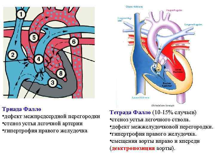 Тетрада фалло