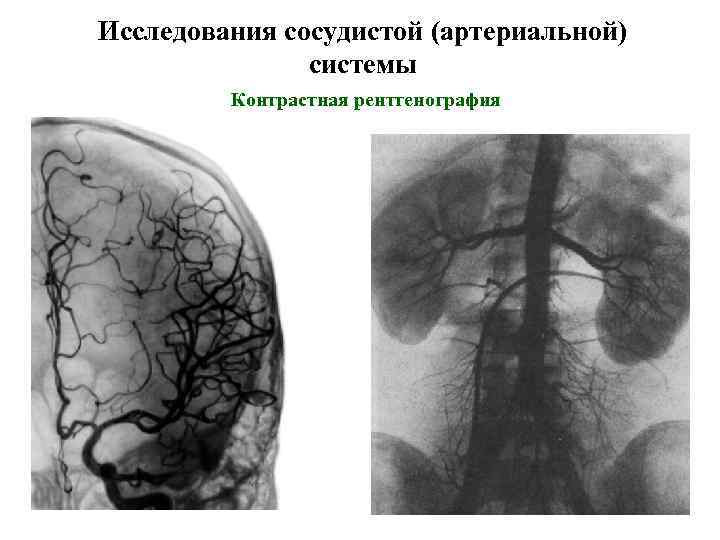 Исследования сосудистой (артериальной) системы Контрастная рентгенография 