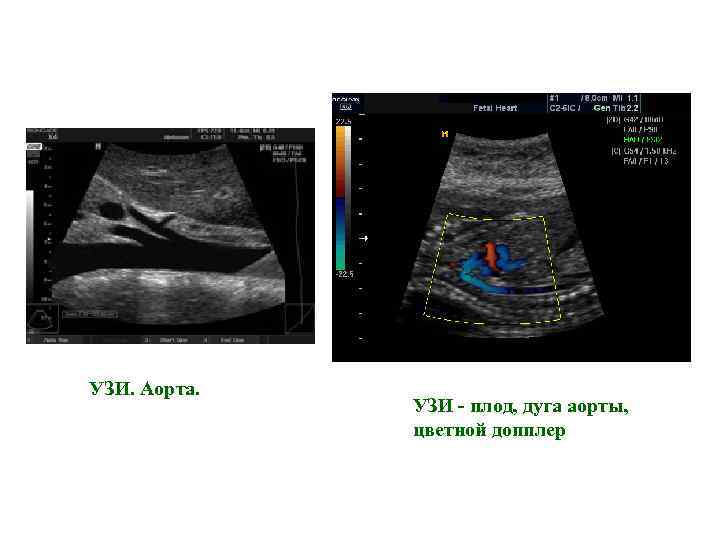 УЗИ. Аорта. УЗИ - плод, дуга аорты, цветной допплер 
