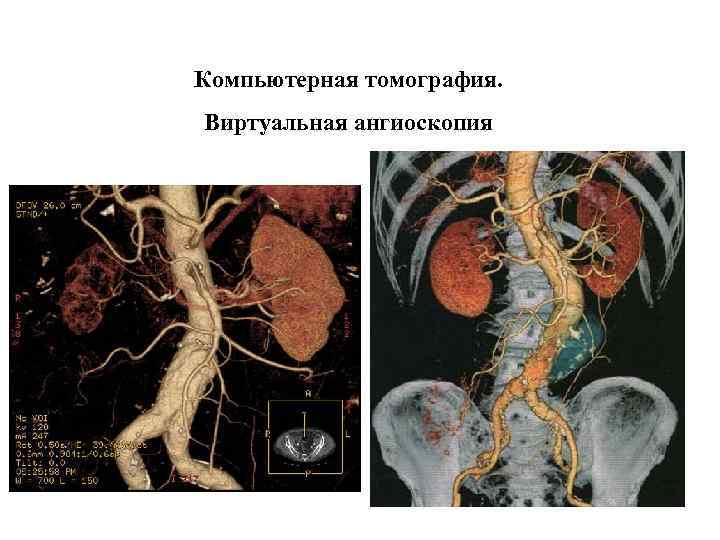 Компьютерная томография. Виртуальная ангиоскопия 