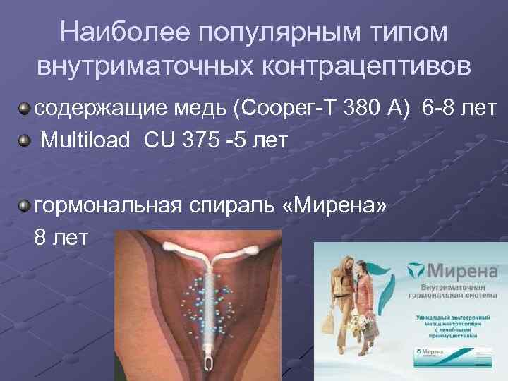 Наиболее популярным типом внутриматочных контрацептивов содержащие медь (Сoорег-Т 380 А) 6 -8 лет Multiload