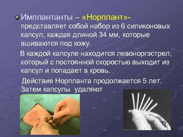 Имплантанты – «Норплант» - представляет собой набор из 6 силиконовых капсул, каждая длиной 34