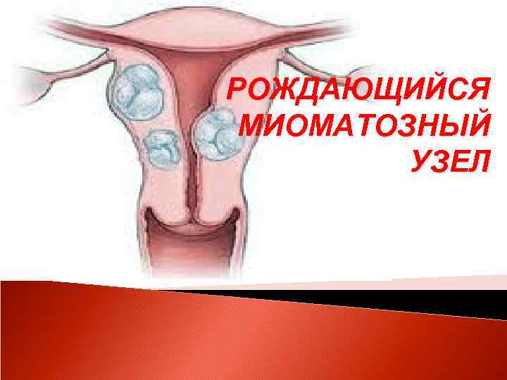 РОЖДАЮЩИЙСЯ МИОМАТОЗНЫЙ УЗЕЛ 