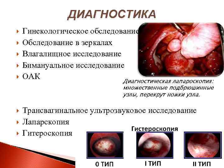 Миоматозный узел рождающийся фото