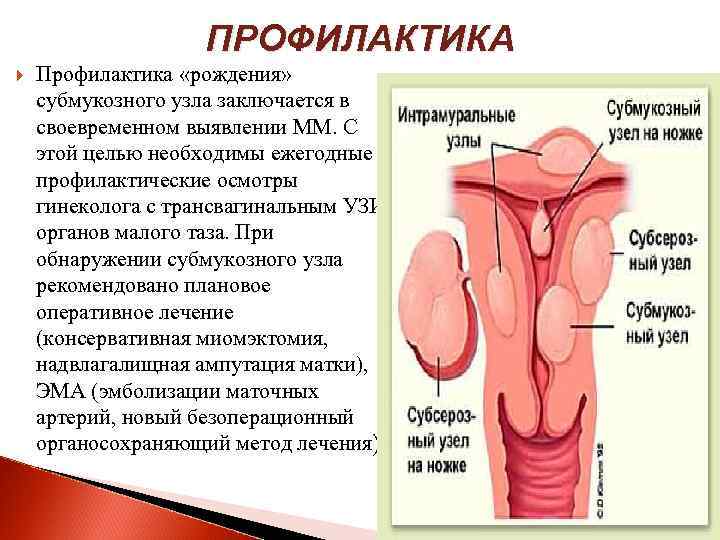 ПРОФИЛАКТИКА Профилактика «рождения» субмукозного узла заключается в своевременном выявлении ММ. С этой целью необходимы