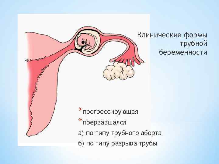 Клиническая картина разрыва маточной трубы