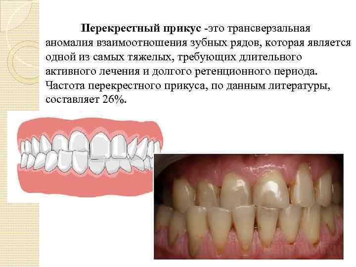 Ретенционные аппараты презентация