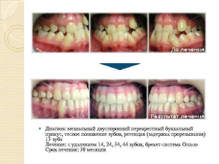  Диагноз: мезиальный двусторонний перекрестный буккальный прикус, тесное положение зубов, ретенция (задержка прорезывания) 13