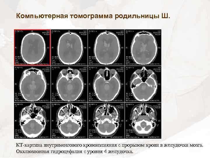 Компьютерная томограмма родильницы Ш. КТ-картина внутримозгового кровоизлияния с прорывом крови в желудочки мозга. Окклюзионная