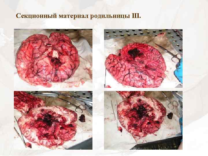 Секционный материал родильницы Ш. 