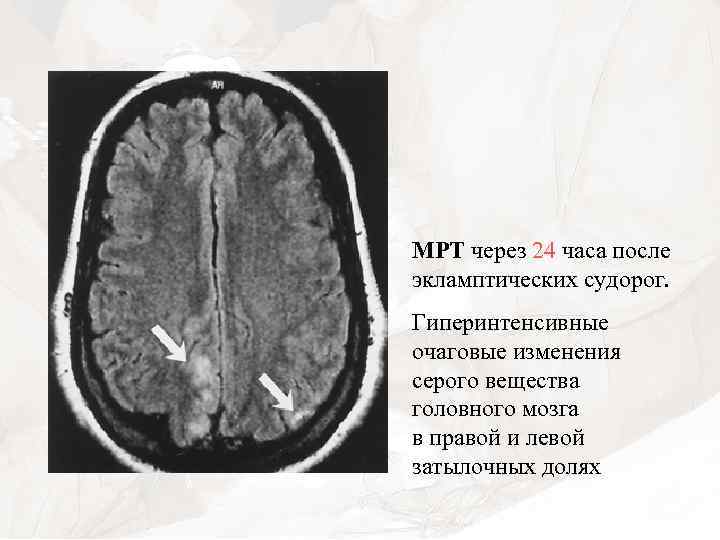 МРТ через 24 часа после экламптических судорог. Гиперинтенсивные очаговые изменения серого вещества головного мозга