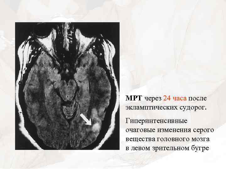 МРТ через 24 часа после экламптических судорог. Гиперинтенсивные очаговые изменения серого вещества головного мозга