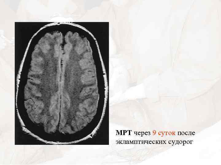 МРТ через 9 суток после экламптических судорог 
