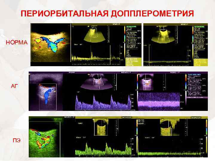 ПЕРИОРБИТАЛЬНАЯ ДОППЛЕРОМЕТРИЯ НОРМА АГ ПЭ 