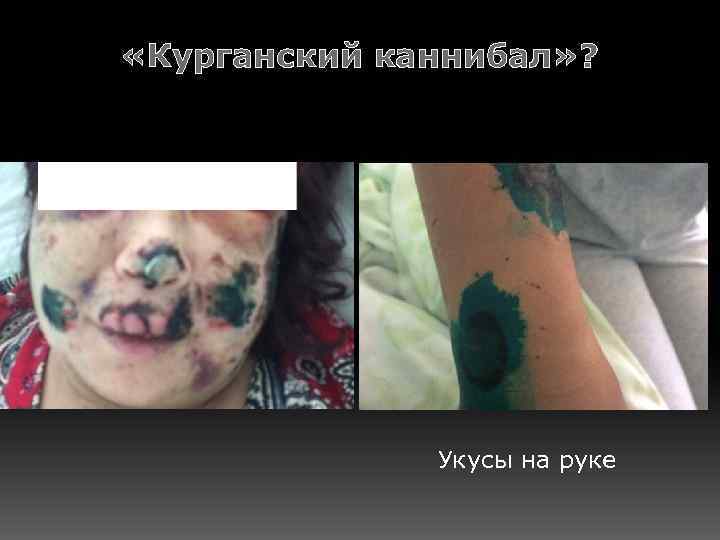  «Курганский каннибал» ? Укусы на руке 