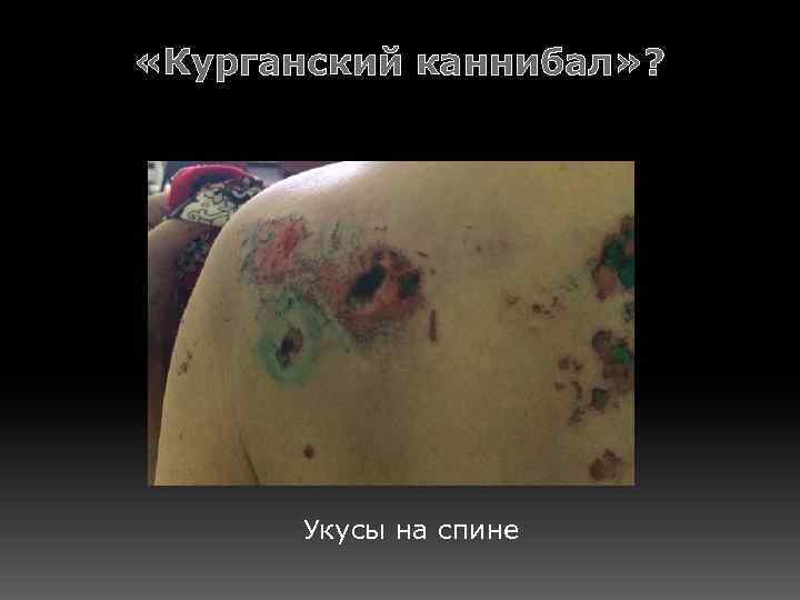  «Курганский каннибал» ? Укусы на спине 