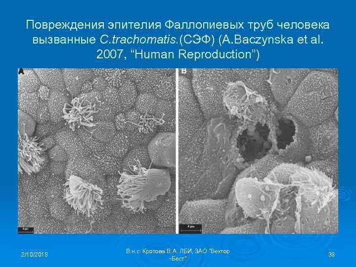 Повреждения эпителия Фаллопиевых труб человека вызванные C. trachomatis. (СЭФ) (A. Baczynska et al. 2007,