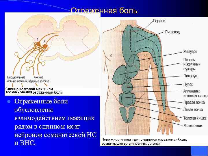 Отраженная боль l Отраженные боли обусловлены взаимодействием лежащих рядом в спинном мозг нейронов соманитеской