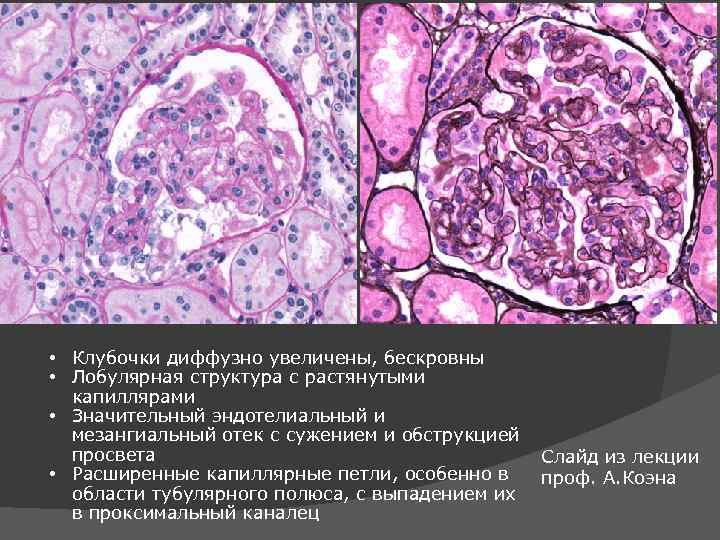  • Клубочки диффузно увеличены, бескровны • Лобулярная структура с растянутыми капиллярами • Значительный
