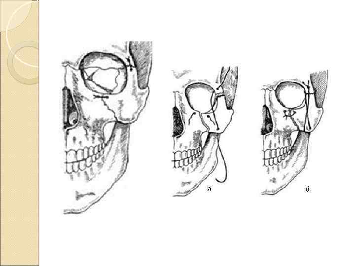 Переломы скуловой кости и дуги презентация