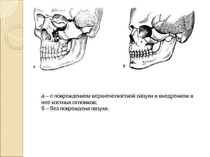 Переломы скуловой кости и дуги презентация