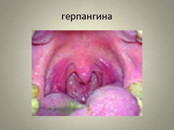 герпангина 