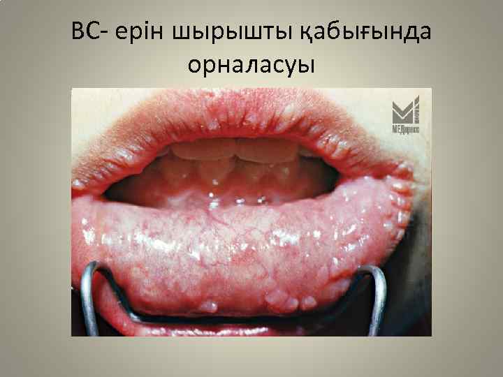 ВС- ерін шырышты қабығында орналасуы 