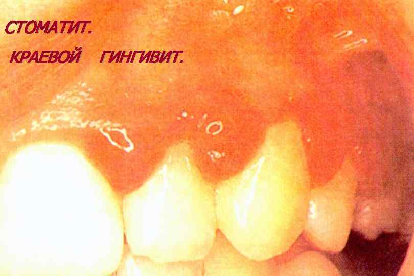 СТОМАТИТ. КРАЕВОЙ ГИНГИВИТ. 