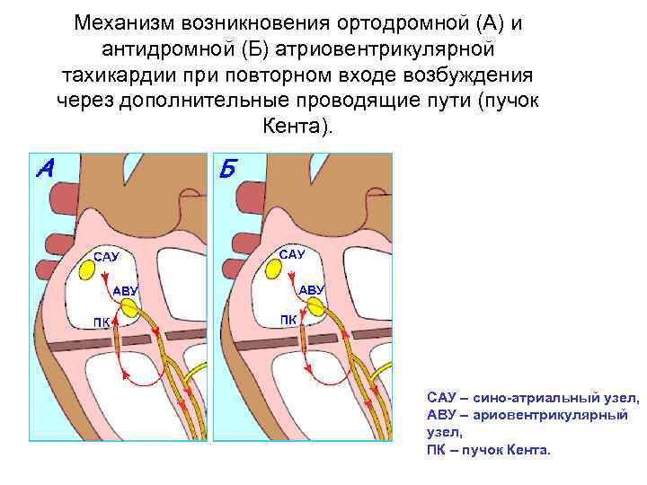 Механизм возникновения ортодромной (А) и антидромной (Б) атриовентрикулярной тахикардии при повторном входе возбуждения через