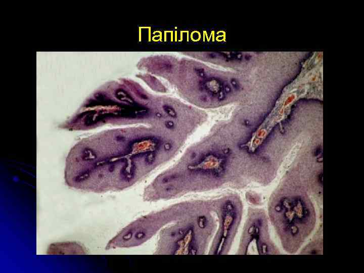 Папілома 
