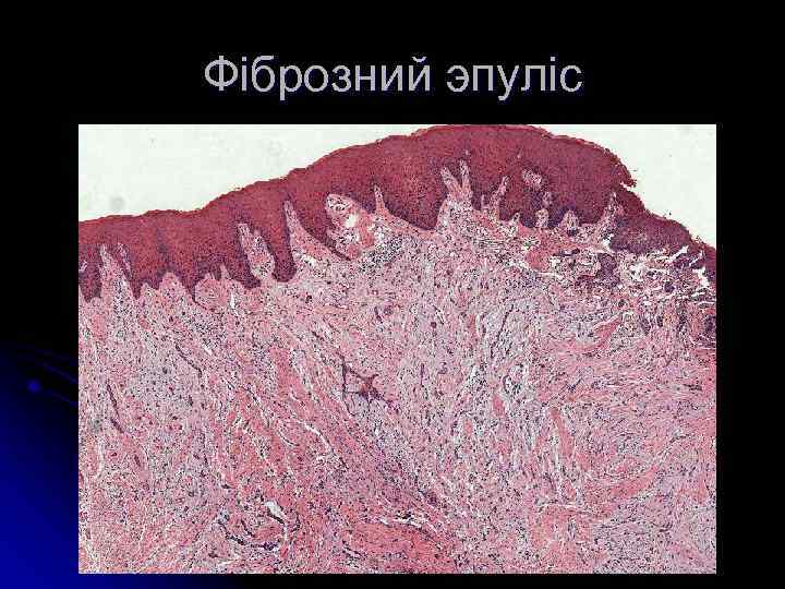 Фіброзний эпуліс 