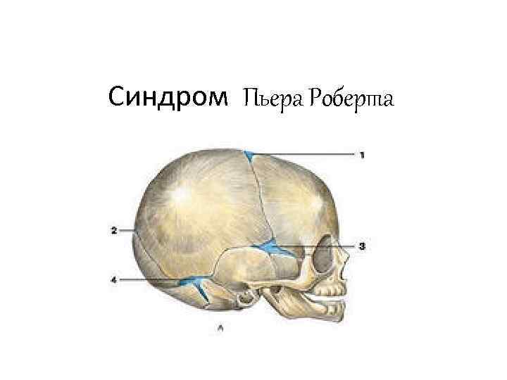 Синдром Пьера Роберта 
