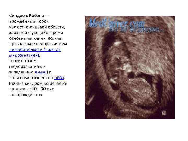 Синдром Ро бена — врождённый порок челюстно-лицевой области, характеризующийся тремя основными клиническими признаками: недоразвитием