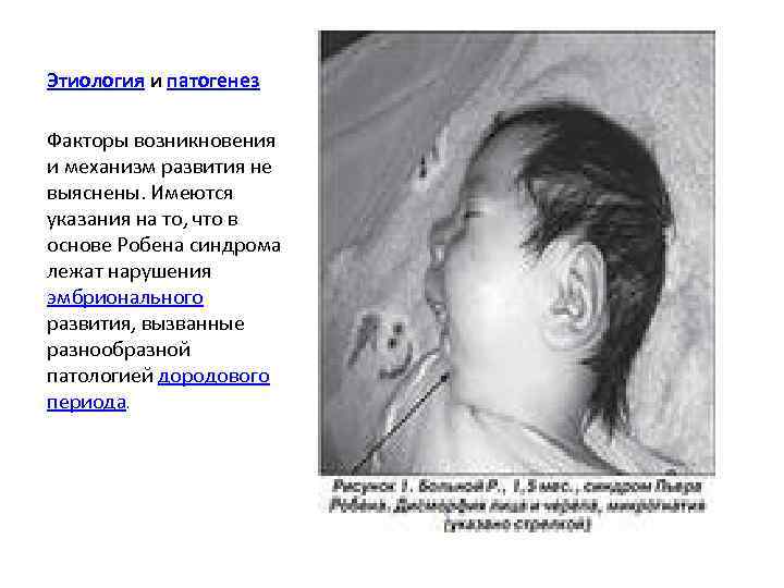 Этиология и патогенез Факторы возникновения и механизм развития не выяснены. Имеются указания на то,