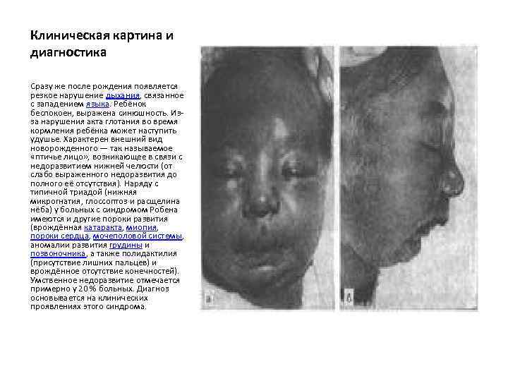 Клиническая картина и диагностика Сразу же после рождения появляется резкое нарушение дыхания, связанное с