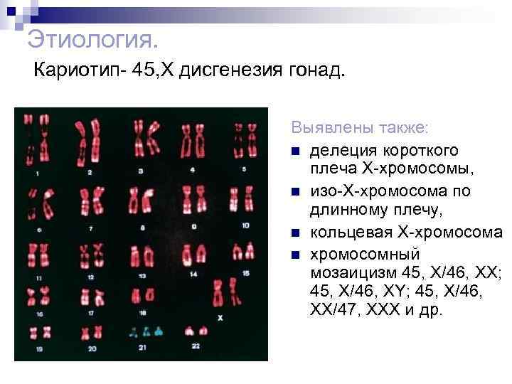 Имеется кольцевая хромосома. Кариотип 45, х3 46 хх22. Синдром Шерешевского Тернера кариотип. Кариотип y0.