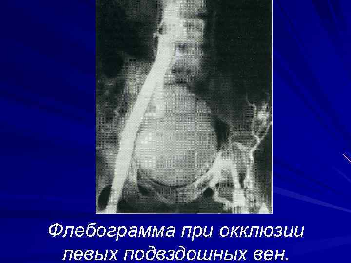 Флебограмма при окклюзии левых подвздошных вен. 