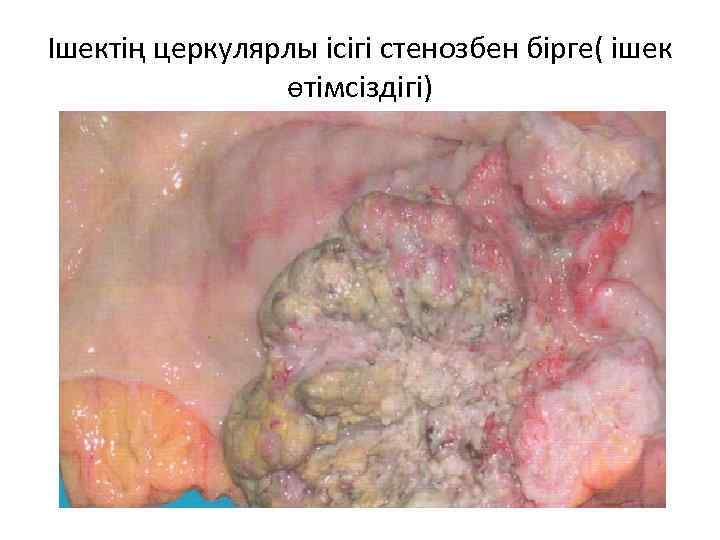 Ішектің церкулярлы ісігі стенозбен бірге( ішек өтімсіздігі) 