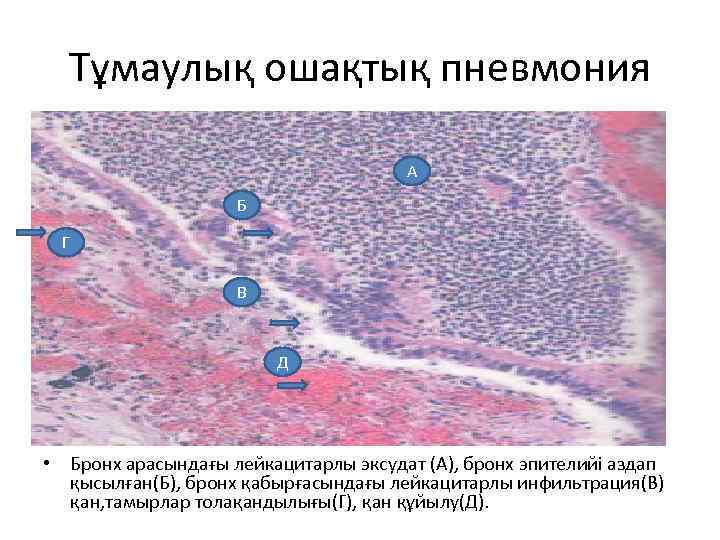 Тұмаулық ошақтық пневмония А Б Г В Д • Бронх арасындағы лейкацитарлы эксудат (А),