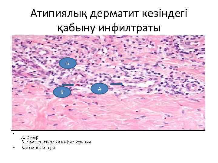 Атипиялық дерматит кезіндегі қабыну инфилтраты Б В • • А. тамыр Б. лимфоцитарлық инфильтрация