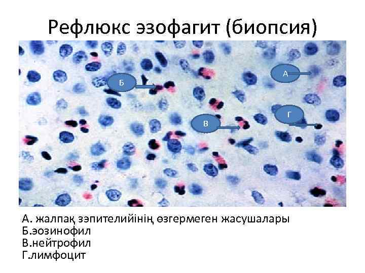 Рефлюкс эзофагит (биопсия) А Б В Г А. жалпақ зэпителийінің өзгермеген жасушалары Б. эозинофил