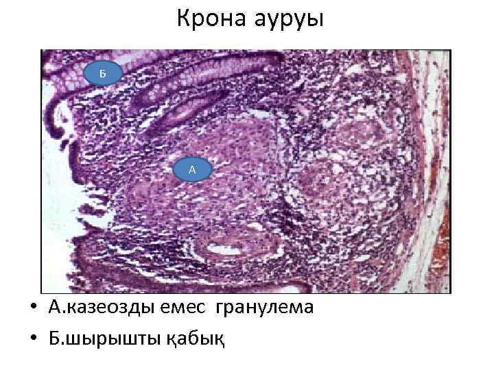 Крона ауруы Б А • А. казеозды емес гранулема • Б. шырышты қабық 