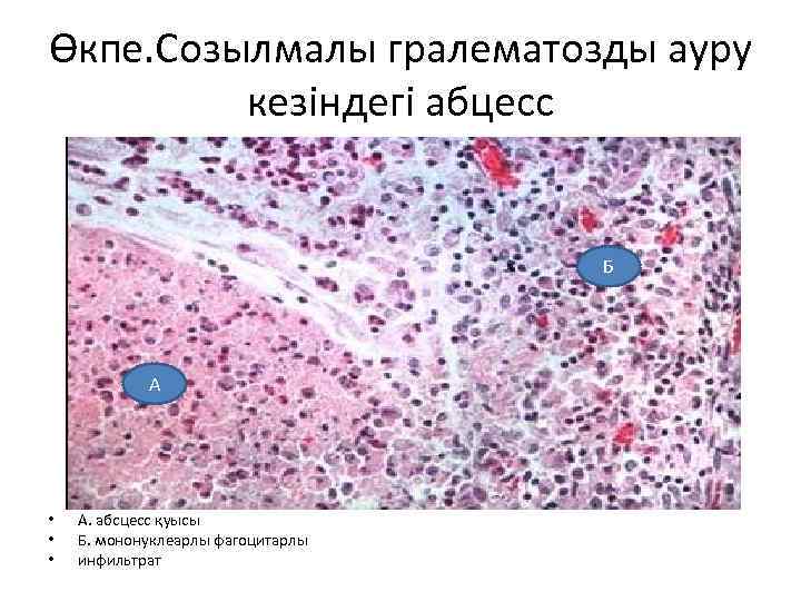 Өкпе. Созылмалы гралематозды ауру кезіндегі абцесс Б А • • • А. абсцесс қуысы