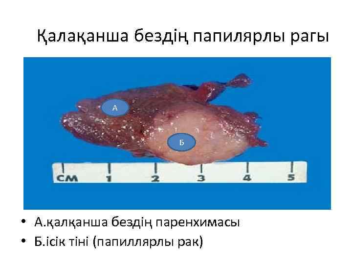 Қалақанша бездің папилярлы рагы А Б • А. қалқанша бездің паренхимасы • Б. ісік